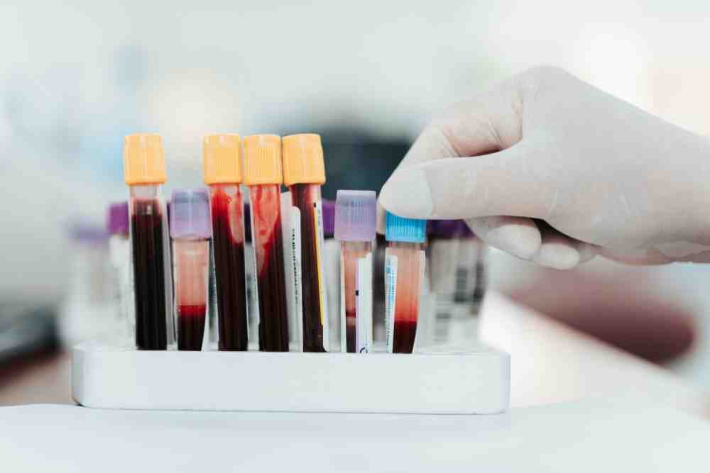 fioles-analyses-sanguines-bilirubine Fioles pour analyses sanguines de la bilirubine