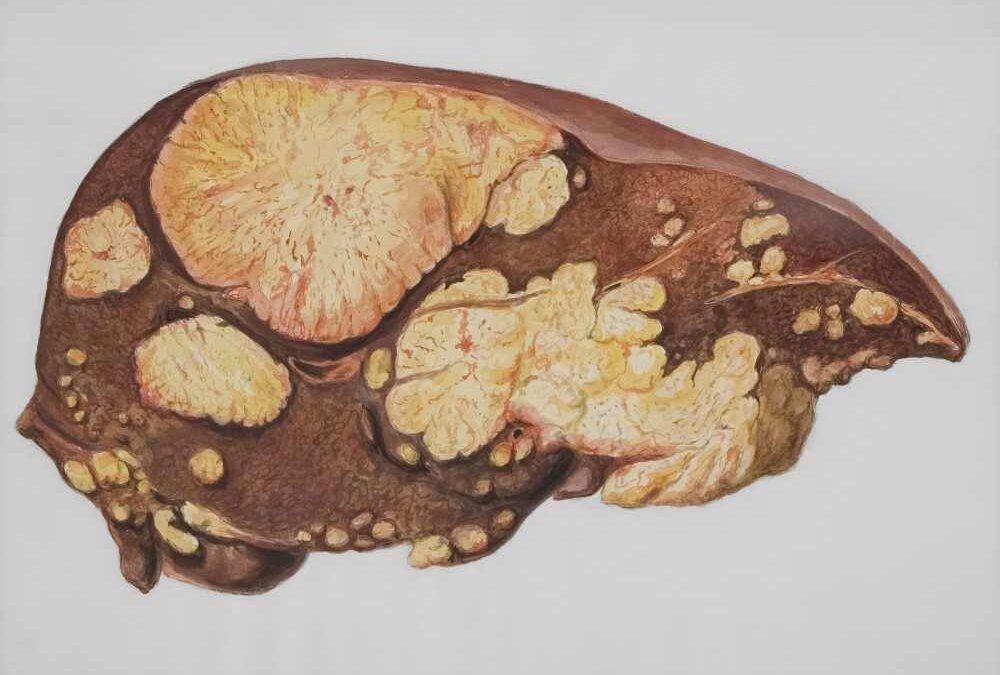 7 signes qui montrent que votre foie est malade