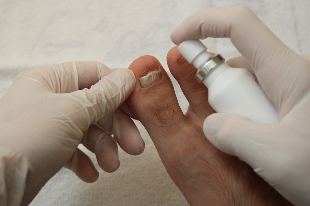 Mycose ongle pied : Traitement efficace et rapide