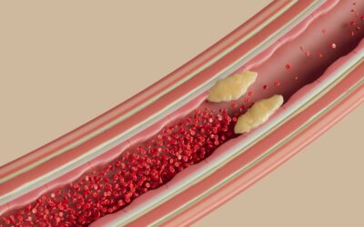 Hypercholestérolémie familiale : Symptômes, espérance de vie