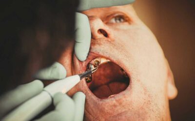 Soins dentaires non remboursés par la Sécurité sociale