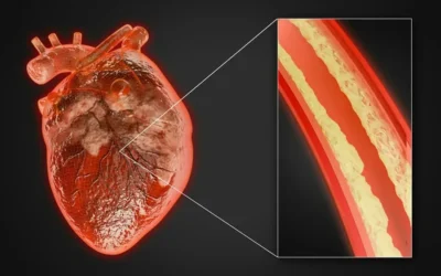 Diabète et cholestérol : Comprendre le lien et agir