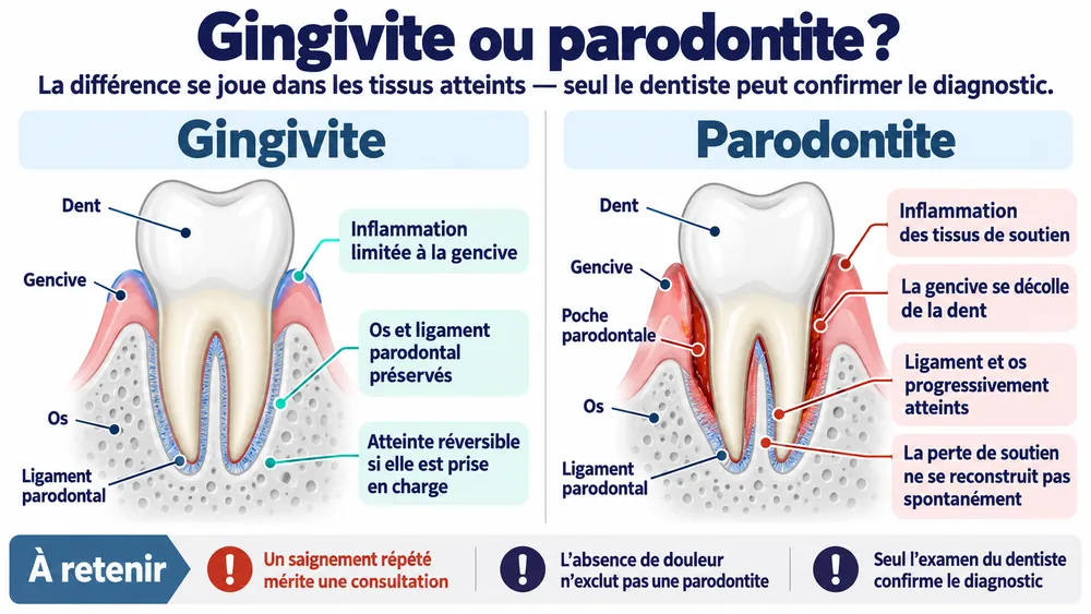 gingivite-ou-parodontite-difference-tissus-atteints Gingivite ou parodontite ? : la différence se joue dans les tissus atteints — seul le dentiste peut confirmer le diagnostic