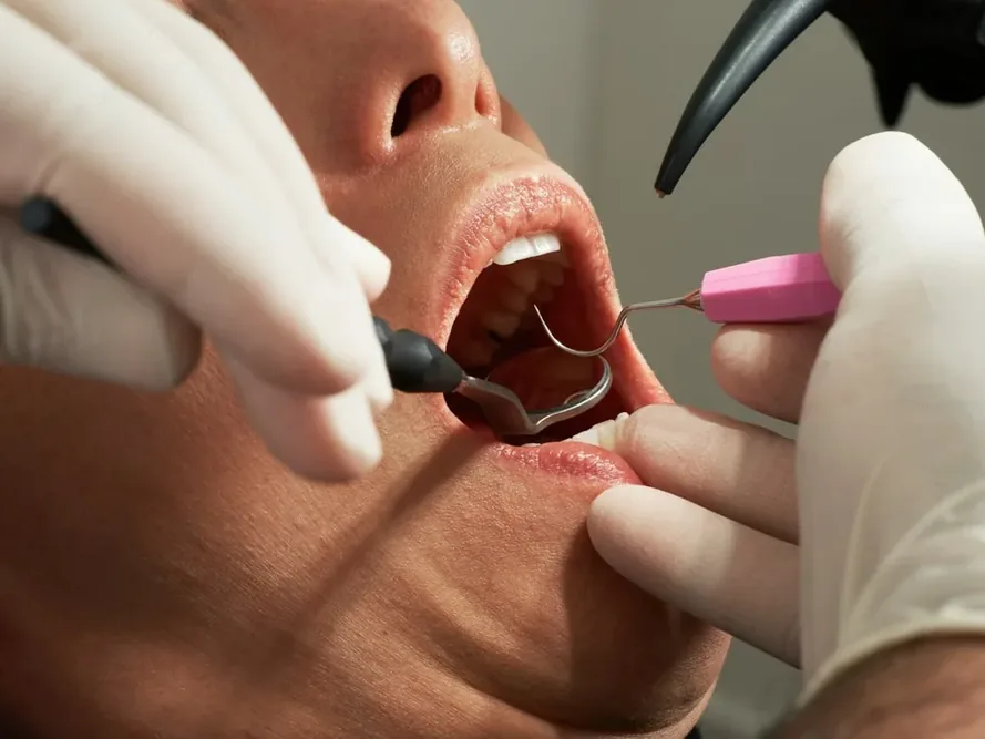 Parodontite : causes, symptômes et soins des gencives — illustration 1 Gingivite ou parodontite ? : la différence se joue dans les tissus atteints — seul le dentiste peut confirmer le diagnostic.