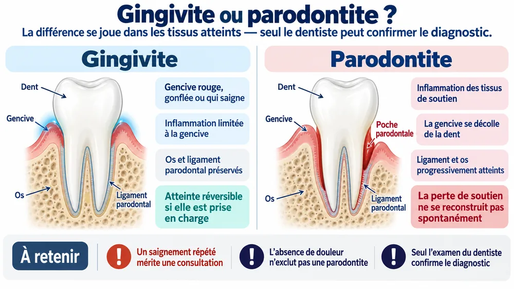 Gingivite ou parodontite ? la différence se joue dans les tissus atteints : seul un dentiste peut confirmer le diagnostic.