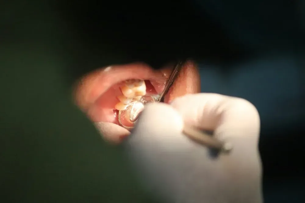 Granulome dentaire : une personne tient une brosse à dents pour illustrer la prévention bucco-dentaire.